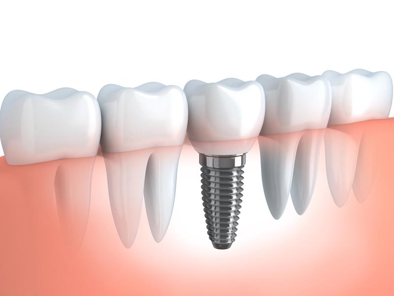 Dental Implants Hastings, NE